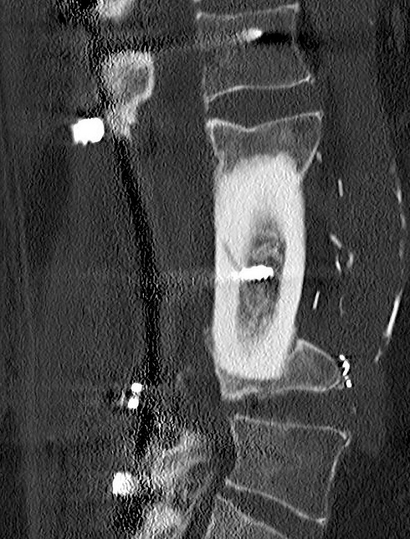 Immagine radiografica di impianto di innesto omologo nella colonna vertebrale