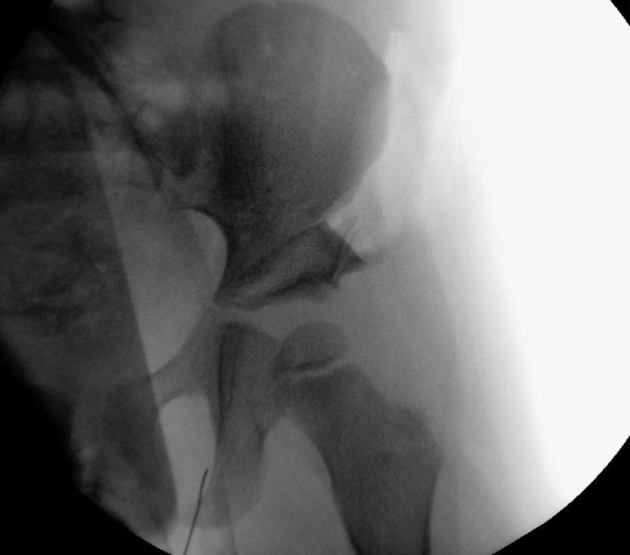 Immagine radiografica displasia congenita anca