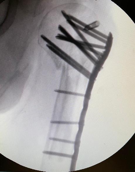 Immagine radiografica del collo dell'omero trattato chirurgicamente per pseudoartrosi