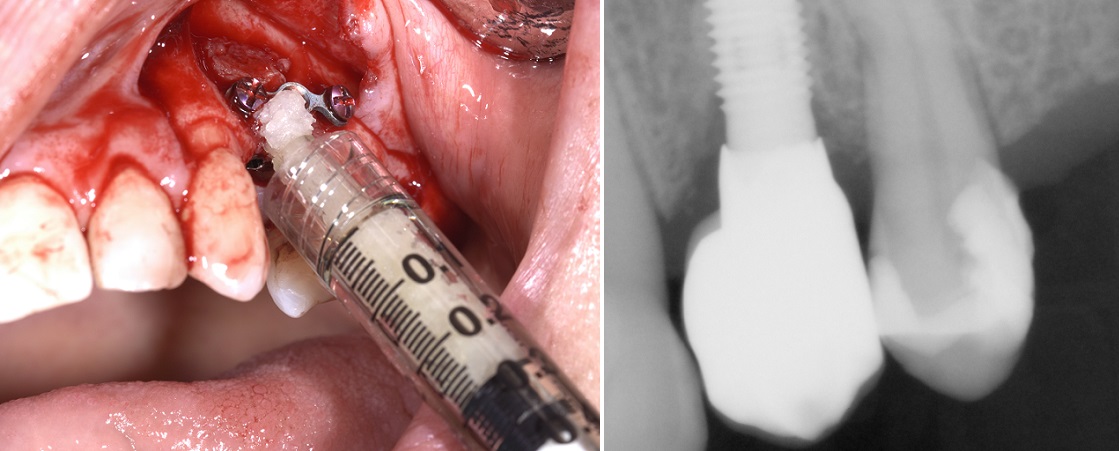 Applicazione di riempitivi ossei in campo odontoiatrico