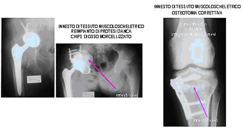 Innesti di tessuto osseo in chirurgia protesica e in occasione di osteotomia correttiva