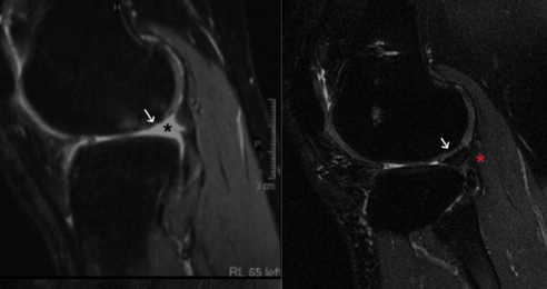   MRI of external meniscus transplant, on the left it is possible to notice the defect caused by a previous removal (black star). On the right, the defect is corrected by the transplanted meniscus (red star). Zaffagnini et al. Arthroscopy 2019