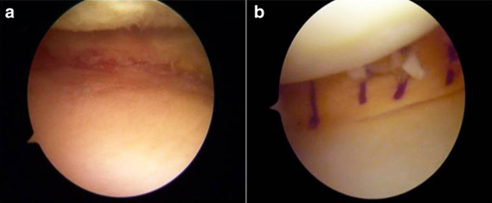 Visione artroscopica di un trapianto di menisco mediale. A sinistra è possibile apprezzare il difetto causato da una precedente rimozione. A destra il difetto meniscale è colmato dal menisco da donatore, che risulta interposto tra il femore e la tibia attutendo il carico. Da “Zaffagnini et al. JEO 2019”