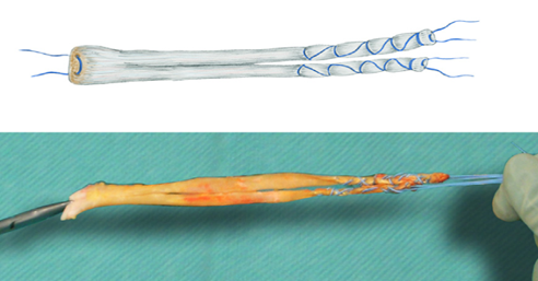 Tendine di Achille da donatore utilizzato per ricostruzioni legamentose del ginocchio. Da “Zaffagnini et al. OTSR 2017”
