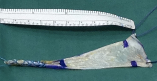 Fascia lata da donatore utilizzata per la ricostruzione dei legamenti rotulei del ginocchio. Da “Zaffagnini et al. KSSTA 2014”