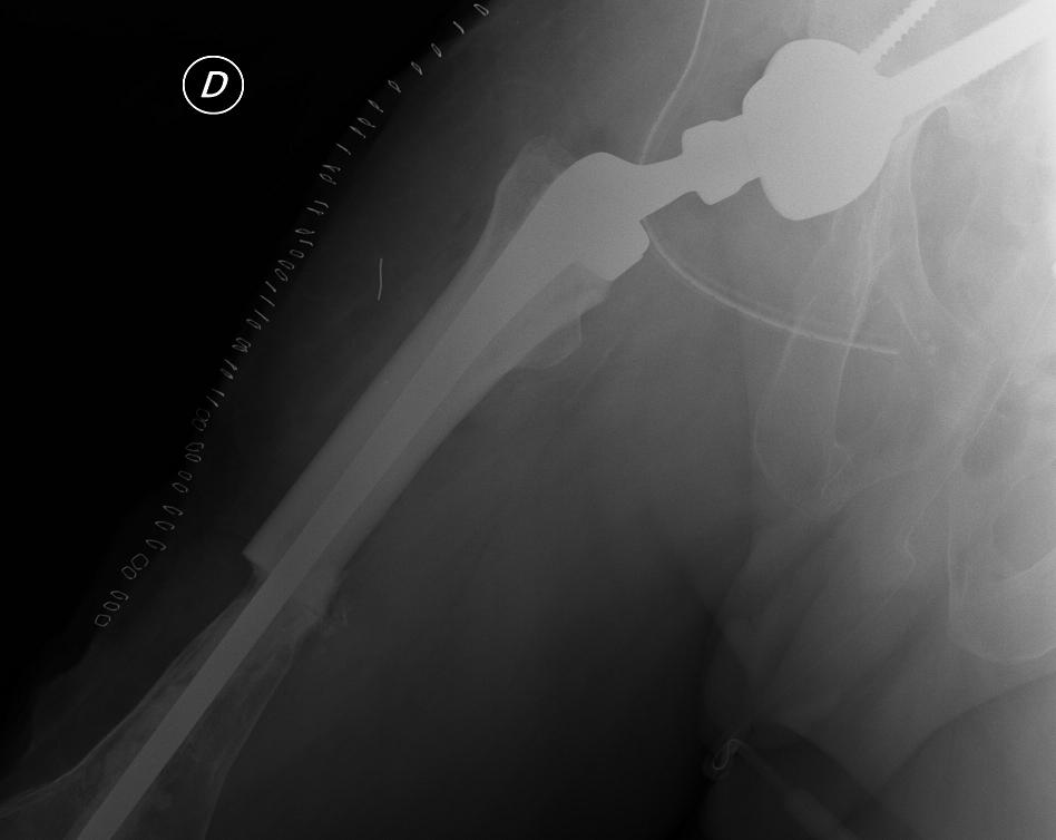 Immagine radiografica di protesi composita
